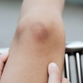 5 Effective Ways to Get Rid of Bruises