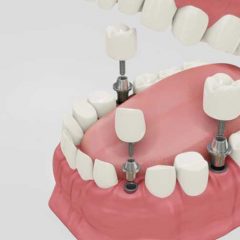 5 Important Reasons to Replace Missing Teeth