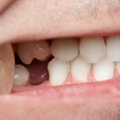 5 Ways Missing Teeth Can Harm Your Dental Health-b8748478