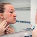 5 Causes of Hives on Your Face-e138fb91