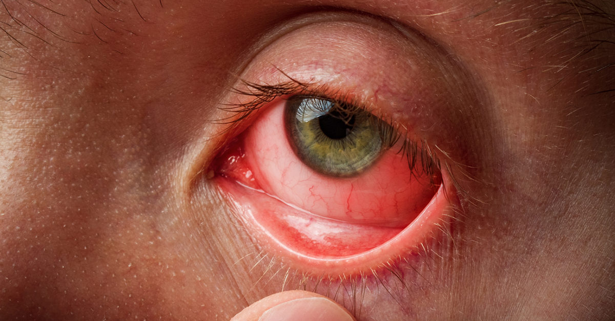 5 Main Eye Infections Everyone Should Be Aware Of-dcf068ea