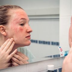 5 Causes of Hives on Your Face-e138fb91
