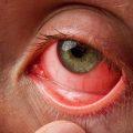 5 Main Eye Infections Everyone Should Be Aware Of-dcf068ea