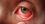 5 Main Eye Infections Everyone Should Be Aware Of-dcf068ea