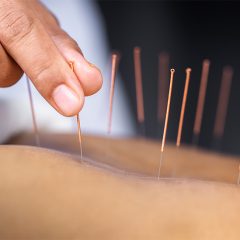 Everything You Should Know About Acupuncture for Plantar Fasciitis-6beba3ad