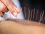Everything You Should Know About Acupuncture for Plantar Fasciitis-6beba3ad