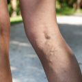 varicose_veins_blood_clots_fb-0a3c8641