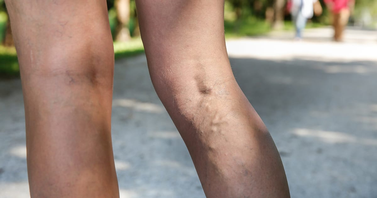 varicose_veins_blood_clots_fb-0a3c8641