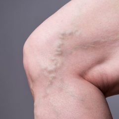 5 Myths About Varicose Veins You Need to Stop Believing-26d441c0