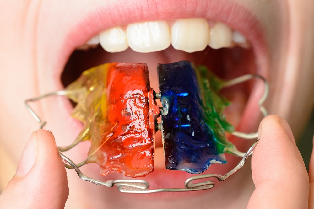 Everything You’d Like to Know About Retainers for Kids
