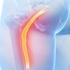 How to Get Sciatic Pain Relief