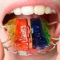 Everything You’d Like to Know About Retainers for Kids