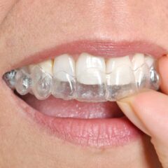 Invisalign-tips