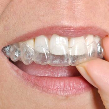 Invisalign-tips