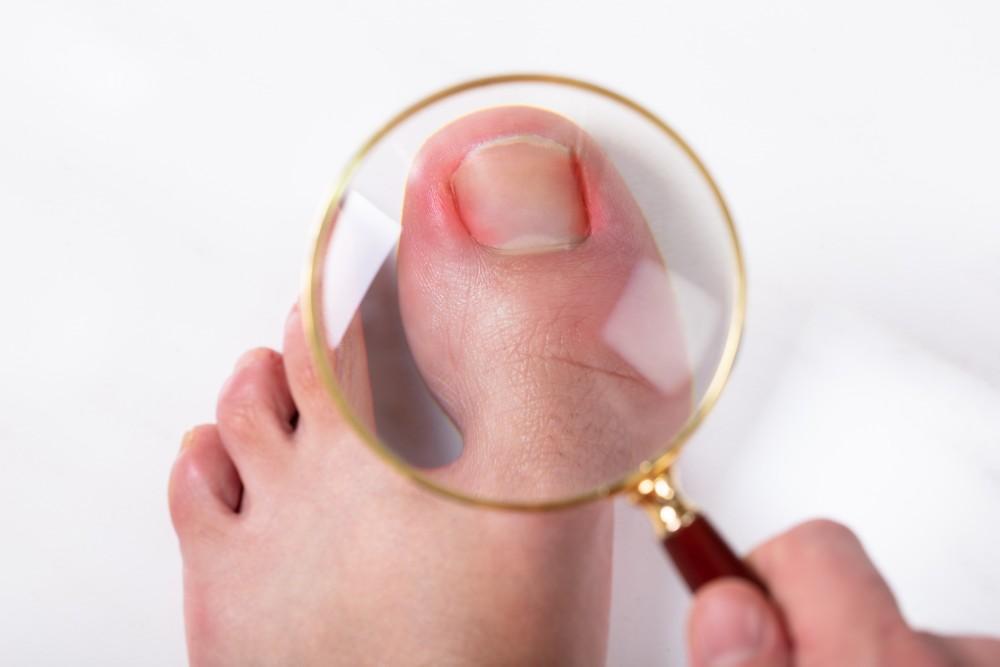 6 Facts About Ingrown Toenails