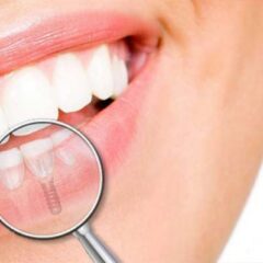 Exploring the Pros and Cons of Dental Implants_ A Comprehensive Guide