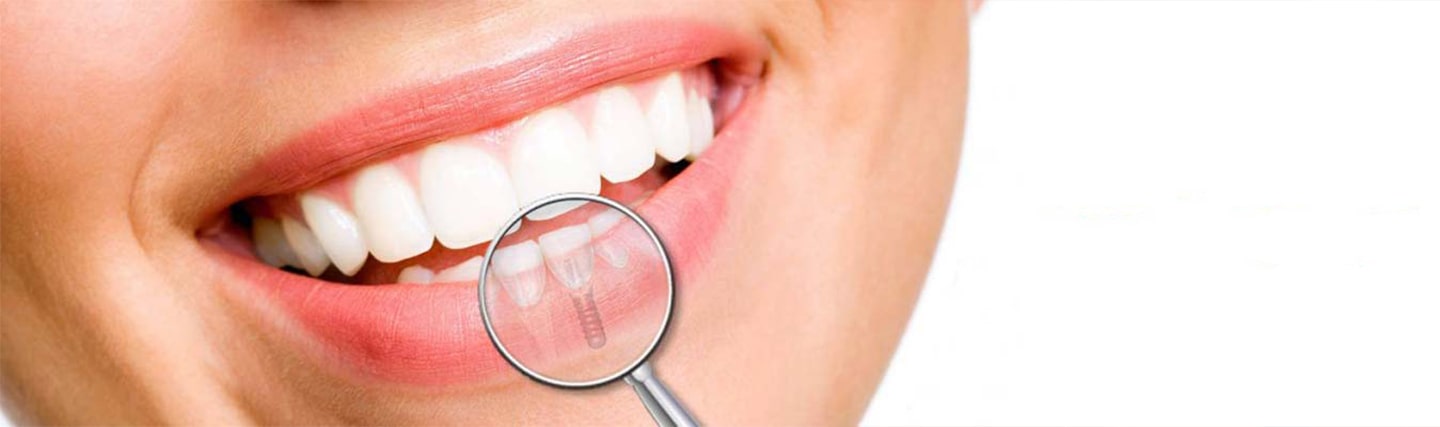 Exploring the Pros and Cons of Dental Implants_ A Comprehensive Guide