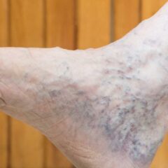 Where To Go For Varicose Veins Treatment