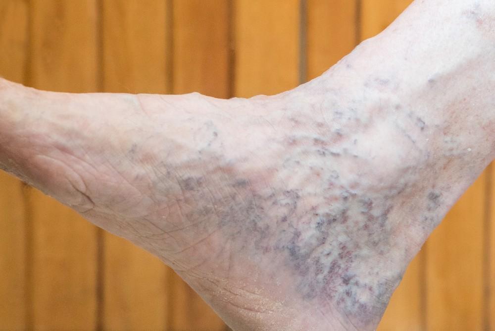 Where To Go For Varicose Veins Treatment