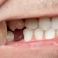Your 3 Best Options for Replacing Missing Teeth