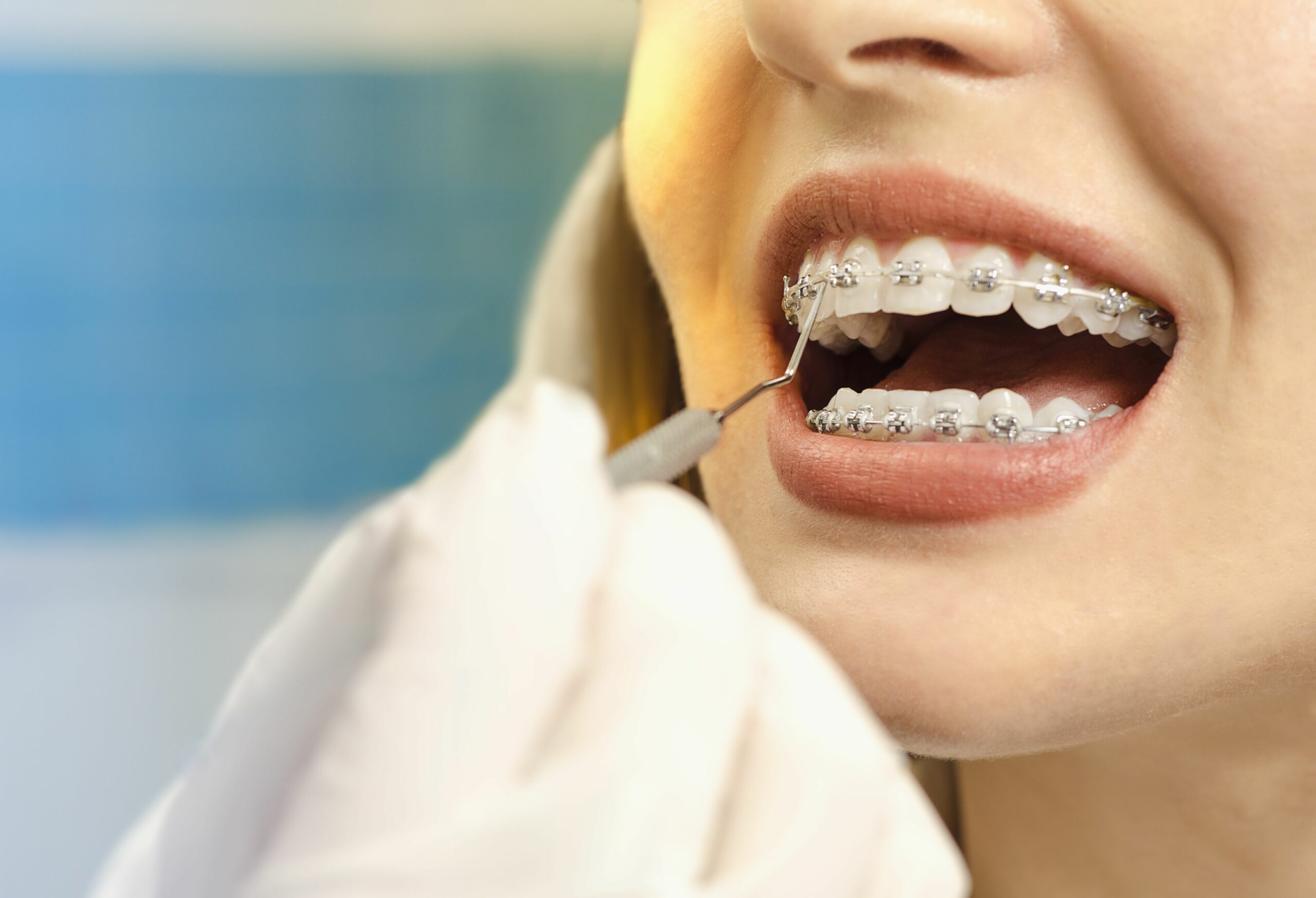 Top 4 Things to Consider Before Getting Adult Braces