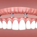 10 Facts You May Not Know About All on 4 Dental Implants
