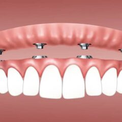 10 Facts You May Not Know About All on 4 Dental Implants