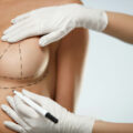 8 Things to Know about Breast Lift