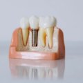 What Is the Difference Between the Materials of Dental Implants