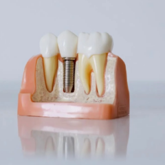 What Is the Difference Between the Materials of Dental Implants