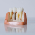 Dental Implant Options For Patients With a Significant Bone Loss