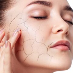 Beat the Heat Essential Tips for Managing Dry Skin This Summer