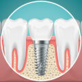 7 Myths About Dental Implants Debunked