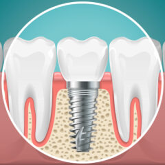 7 Myths About Dental Implants Debunked