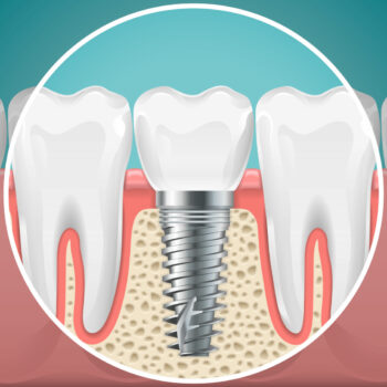 7 Myths About Dental Implants Debunked