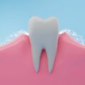 The Magic Silver Shield How Silver Diamine Fluoride Protects Your Teeth from Cavities