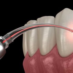 Laser Gum Surgery 101 How This High-Tech Solution Is Revolutionizing Gum Disease Treatment